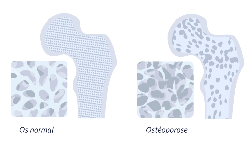 GRIMBERG_Ostéoporose